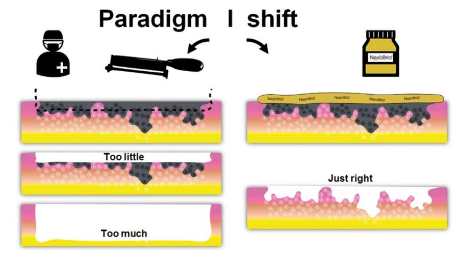 MediWound Paradigmenwechsel