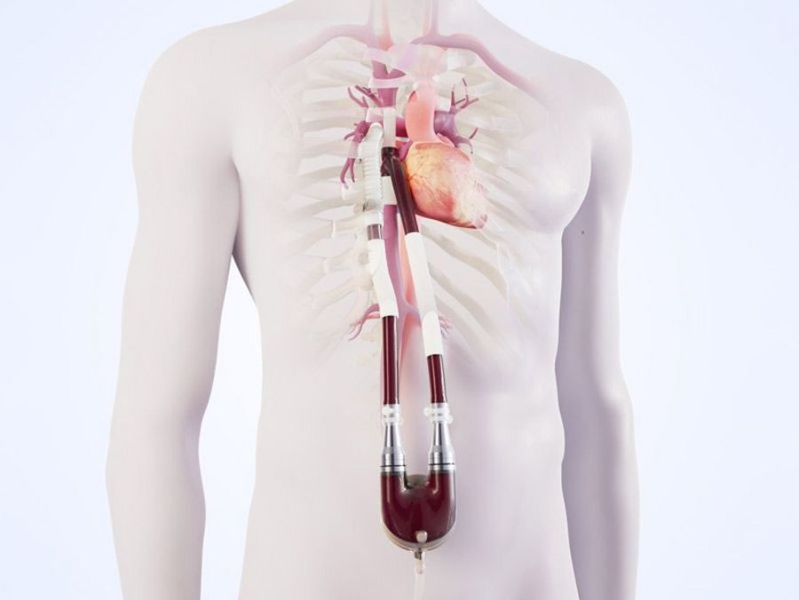 Berlin Heart - EXCOR® Revive System