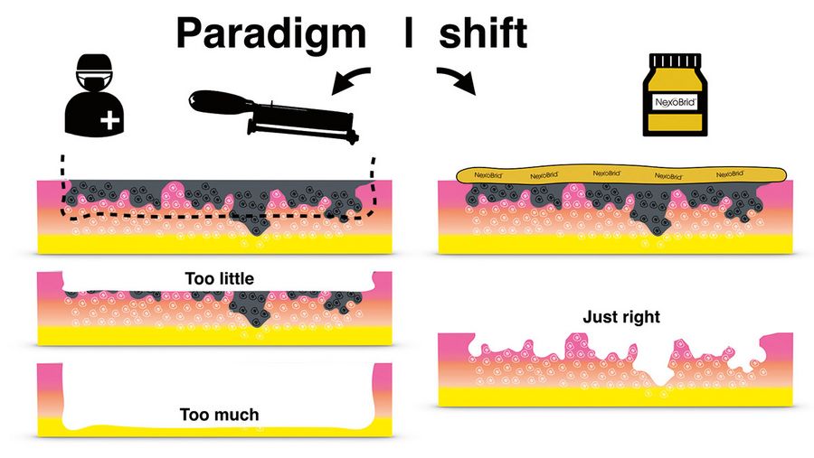 MediWound Paradigmenwechsel