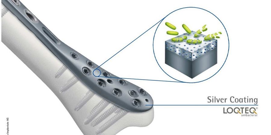 aap implantate antibakteriellen Wirkungsweise der Silberbeschichtungstechnologie