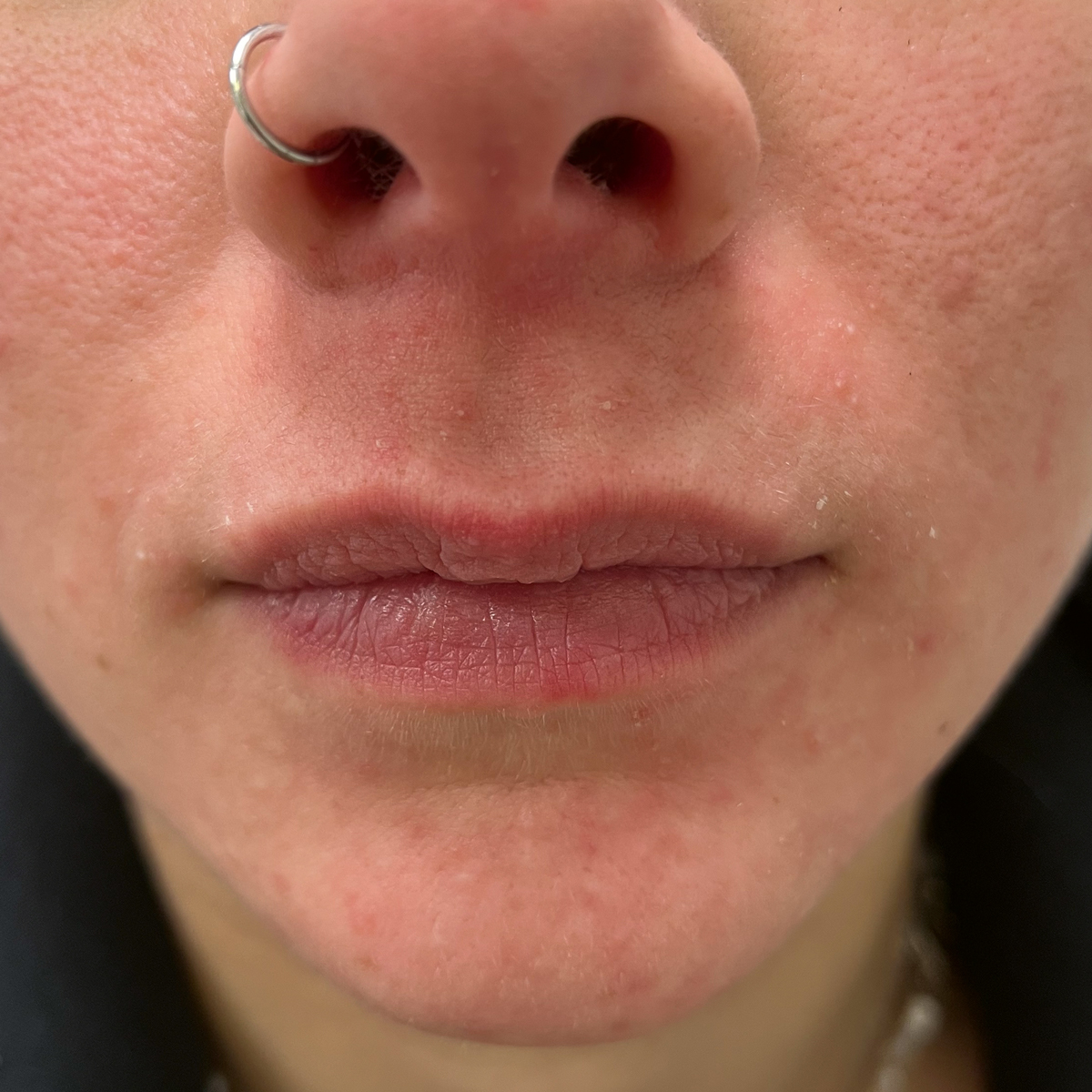 Periorale Dermatitis nach drei Sitzungen mit Kaltplasma