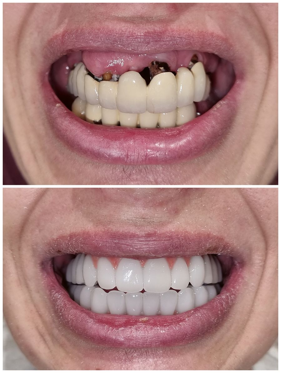 Dr. Ihde Dental AG Behand vorher nachher