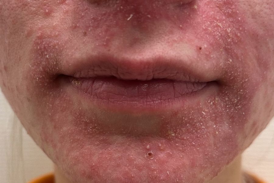 Periorale Dermatitis vor der Behandlung