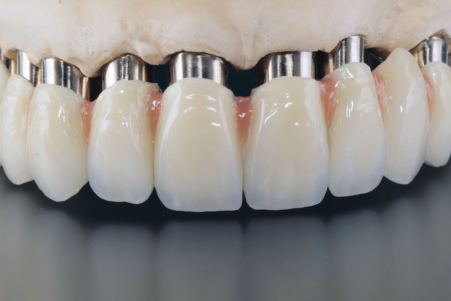 Lentz & Müller Dentaltechnik Implantate